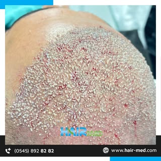 🤩Saçlarınızı yenileme zamanı✨Tüm sorularınız için HairMed her şey dahil hizmet ve 7/24 destek ile h