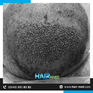 Gür ve sağlıklı saçlar!😎🤩
Tüm sorularınız için HairMed her şey dahil hizmet ve 7/24 destek ile her