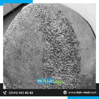 🌟Saç ekimi ile daha dolgun ve sağlıklı saçlara sahip olun.🤩

🌟Have fuller and healthier hair with