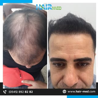 Doğal görünüm, kalıcı sonuçlar👍🏻
Tüm sorularınız için HairMed her şey dahil hizmet ve 7/24 destek 
