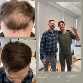 ✨ Incredible transformation alert! ✨ This 33-year-old patient underwent a 2,503 graft hair transplan