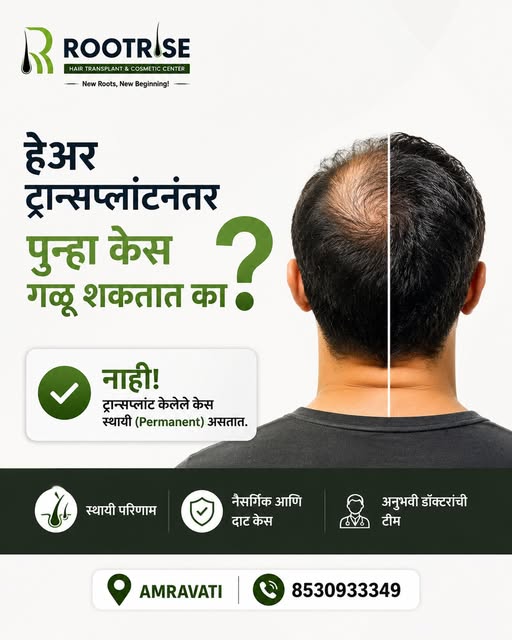 🧑‍🦱 हेअर ट्रान्सप्लांटनंतर पुन्हा केस गळू शकतात का?

सामान्यतः ट्रान्सप्लांट केलेले केस कायमस्वरूप