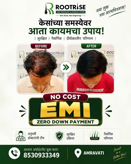 Hair Transplant करायचंय पण एकरकमी खर्चाची चिंता आहे?
आता तुमच्यासाठी NO COST EMI + ZERO DOWN PAYMENT
