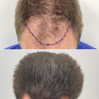 BEFORE AND AFTER - 6 MONTH - HAIR TRANSPLANT
Sessions: 1
Grafts: 2773 Grafts or 7356 Hairs
Photo Gap
