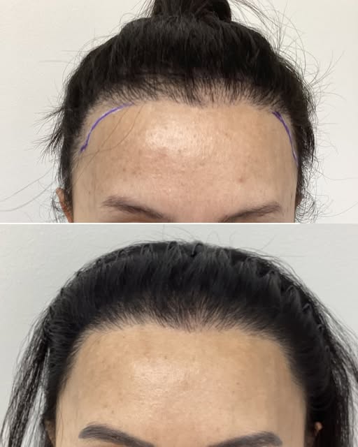 BEFORE AND AFTER - 12 MONTH - HAIR TRANSPLANT
Sessions: 1
Grafts: 1117grafts or 3106hairs
Photo Gap: