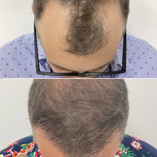 6 MONTHS POST HAIR TRANSPLANT – PROGRESS UPDATE 
This shows a patient 6 months post hair transplant 