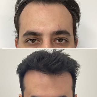 BEFORE AND AFTER - 10 MONTH - HAIR TRANSPLANT
Sessions: 1
Grafts: 2279 Grafts or 5065 Hairs
Photo Ga