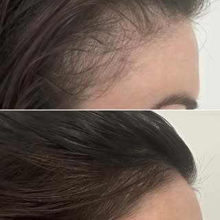 NON-SURGICAL BEFORE AND AFTER - 6 MONTH

This patient presented with temporal hair loss. A non-surgi
