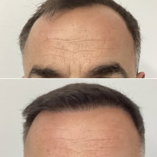 BEFORE AND AFTER - 12 MONTH - HAIR TRANSPLANT
Sessions: 1
Grafts: 3280 Grafts or 9500 Hairs 
Photo G