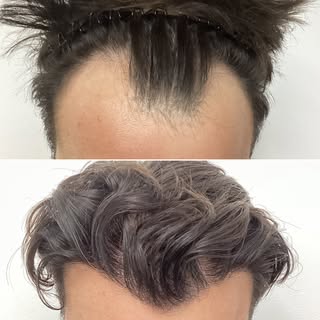 BEFORE AND AFTER - 12 MONTH - HAIR TRANSPLANT
Sessions: 1
Grafts: 3000 Grafts or 8700 Hairs
Photo Ga
