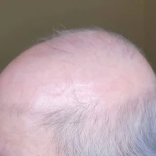 Non-surgical Hair Replacement 

#hairreplacement #hairreplacementsystem #hairststem #hairunit 
#stcl
