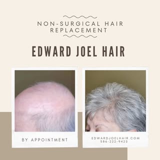 Non-surgical Hair Replacement for Men and Women

#hairsystem #hairreplacement ##hairreplacementsyste