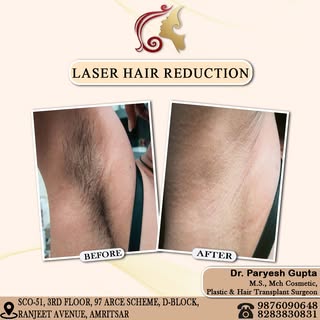 ✨ Say Goodbye to Shaving, Waxing & Ingrown Hair—Hello to Smooth, Hair-Free Skin! 💖

Experience safe