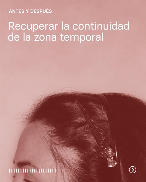 En este caso, el trasplante se ha realizado en la zona temporal.
Al redensificar este área, el marco