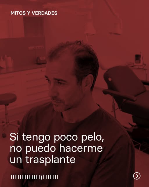 La cantidad de cabello perdido no determina por sí sola si un paciente puede realizarse un trasplant