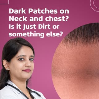 Dark patches on your neck, underarms, or chest? 🖤 Here’s the scoop:
🔹 Retention hyperkeratosis can