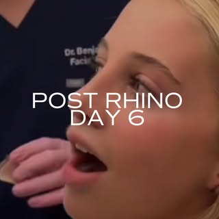 Just 6 days after open rhinoplasty, and my patient is already glowing. She’s thrilled with how natur