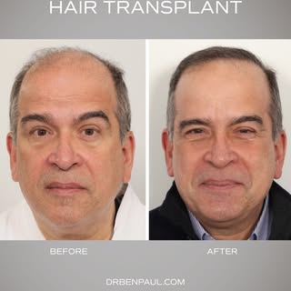 One year after his male hair transplant, the goal was to improve facial framing at the front of his 