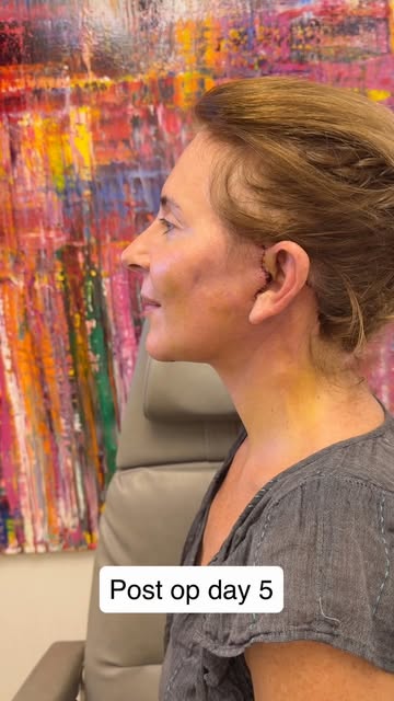 Post op day 5 goals!!!

My patient had an extended deep plane face and neck lift just five days ago.