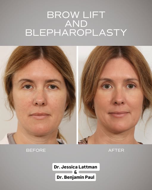 Our patient is one month out from a concurrent upper blepharoplasty by Dr. Jessica Lattman and an en