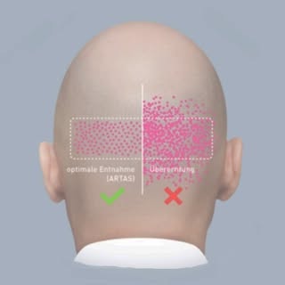 Liebe Patienten,
schauen Sie bei günstig klingende Angeboten für Haartransplantationen bitte genau h