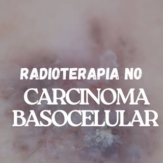 Você sabia que a radioterapia pode ser uma opção de tratamento para o carcinoma basocelular?

Segund