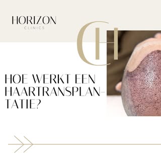 🌱 Hoe werkt een haartransplantatie eigenlijk?

Tijdens een haartransplantatie worden gezonde haarza