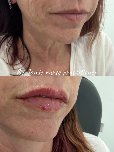 ✨ A little lip refresh can make such a beautiful difference. ✨

This result was all about creating s