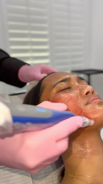 Microneedling season is officially in full swing!
This time of year is the perfect time to start put