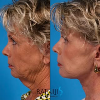 🔹 Before & After: 

🔹 Lower Facelift / Necklift
🔹 Endoscopic Brow Lift
🔹 Laser Skin Resurfacing 