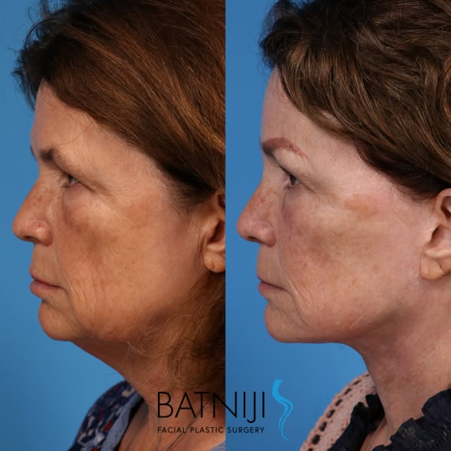 🔹 Before & After: 

🔹 Lower Facelift / Necklift 
🔹 Endoscopic Brow Lift 

☎️ (949) 650-8882
📍 Ne