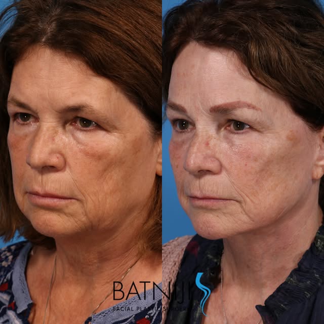 🔹 Before & After: 

🔹 Lower Facelift / Necklift 
🔹 Endoscopic Brow Lift 

☎️ (949) 650-8882
📍 Ne