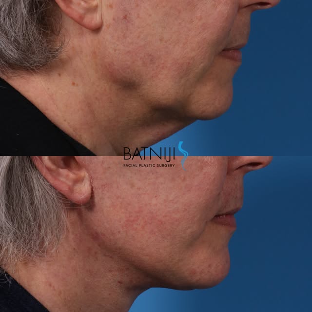 🔹 Before & After: 

🔹 Lower Facelift / Necklift 

☎️ (949) 650-8882
📍 Newport Beach + Beverly Hil