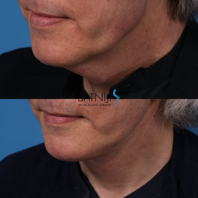 🔹 Before & After: 

🔹 Lower Facelift / Necklift 
 

☎️ (949) 650-8882
📍 Newport Beach + Beverly H