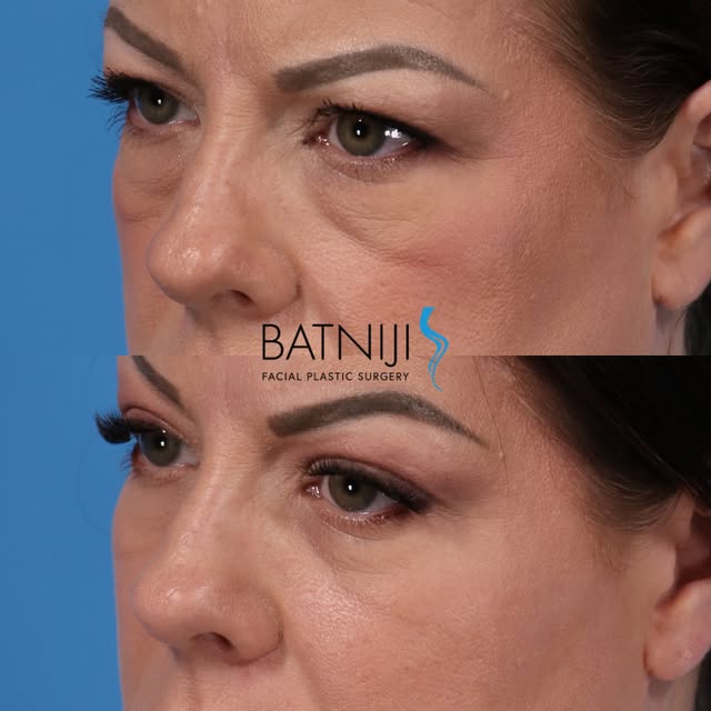 🔹 Before & After: 

🔹 Lower Blepharoplasty (lower eyelid) 

☎️ (949) 650-8882
📍 Newport Beach + B