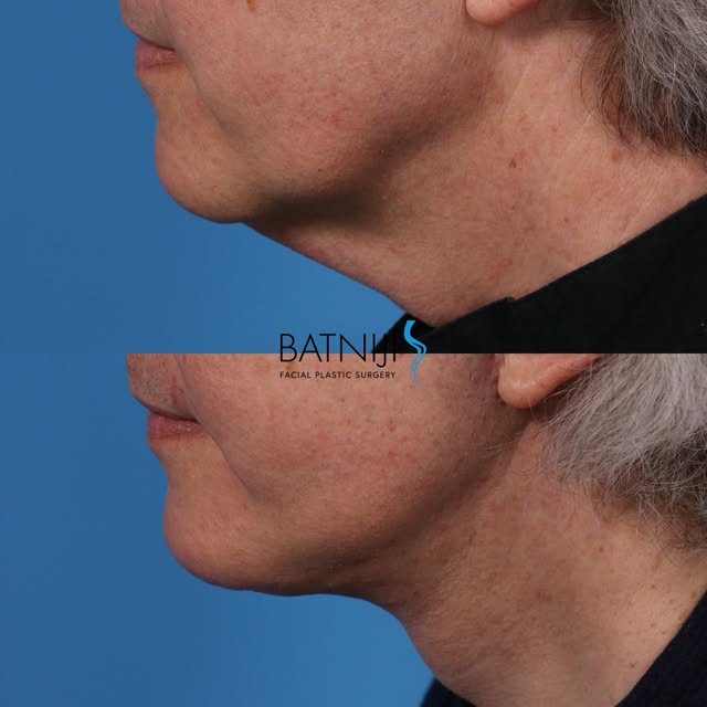 🔹 Before & After: 

🔹 Lower Facelift / Necklift 

☎️ (949) 650-8882
📍 Newport Beach + Beverly Hil