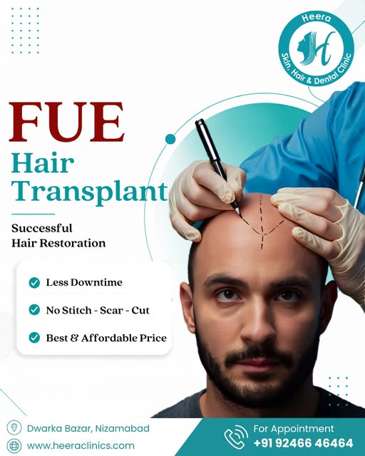 FUE Hair Transplant !!!Successful Hair Restoration *Less Down Time, *No Stitch - Scar - Cut,*Best & 