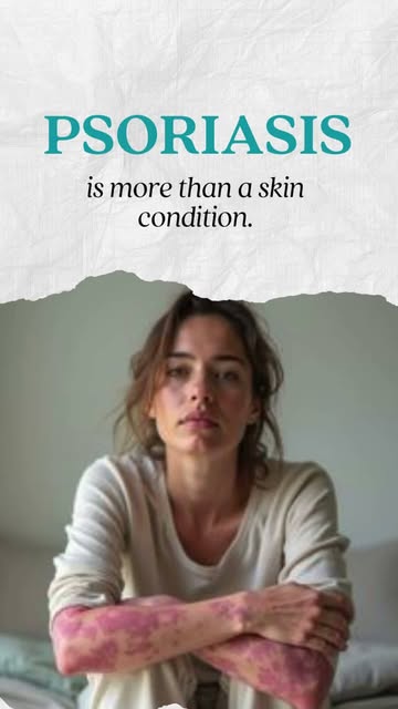 Psoriasis is a chronic skin condition that goes beyond visible symptoms. It can affect daily comfort