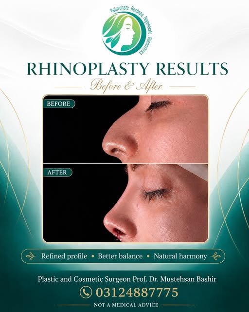 Rhinoplasty before and after: profile refinement with preservation of natural facial harmony.

Rhino