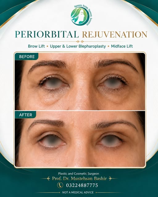 Periorbital rejuvenation is rarely about the eyelids alone.

Ageing around the eyes can involve brow