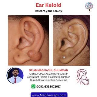 ✨ Smooth, Natural Ears – No More Keloids! 👂

Tired of ear keloids affecting your look or causing di
