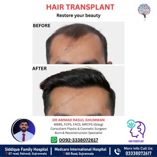 Struggling with hair loss or baldness?
Restore your hairline and confidence with advanced Hair Trans
