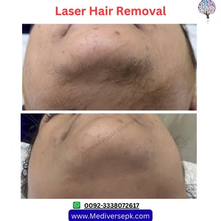 ✨ Still shaving or waxing every few weeks?
It’s time to upgrade 💫

Say goodbye to unwanted hair wit
