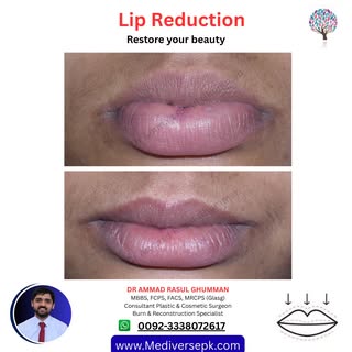 👄 Feel your lips are too large or out of balance?
Refine your look with Lip Reduction Surgery ✨

Ac