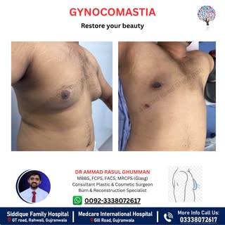 Struggling with Gynecomastia (Male Chest Enlargement)?

Achieve a firmer, more masculine chest conto
