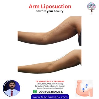 ✨ Dreaming of slimmer, more sculpted arms?

Arm Liposuction can help remove stubborn fat deposits th