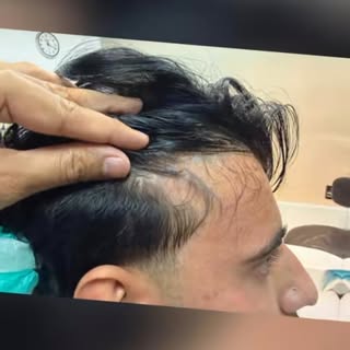 Say goodbye to hair loss and hello to confidence! ✨

A Hair Transplant provides a permanent, natural
