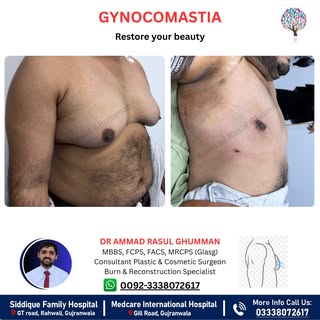 💪 Say Goodbye to Gynecomastia. Restore Your Confidence!

Do you avoid fitted shirts, swimming, or s