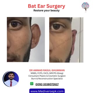 👂 Prominent (Bat) Ears? Enhance Your Confidence with Otoplasty!

If you’re self-conscious about pro