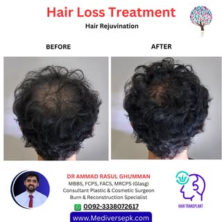 💇‍♂️ Struggling with Hair Loss or Thinning Hair?

Hair loss can affect both your appearance and con
